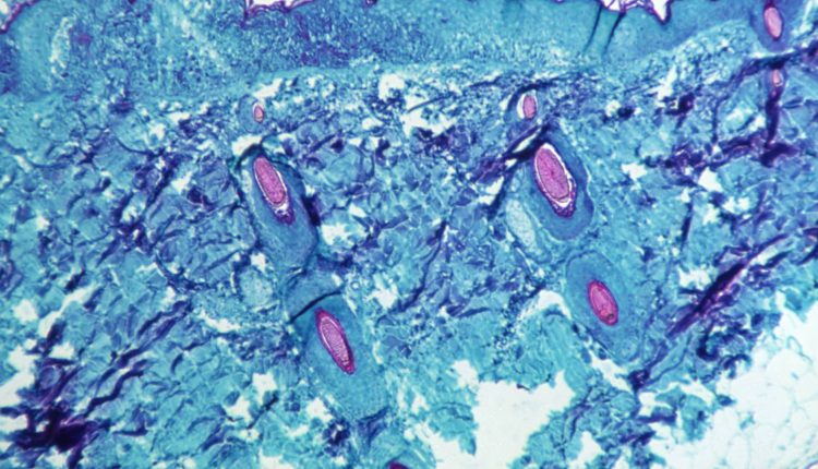 Texas reports what may be the first US death from monkeypox
