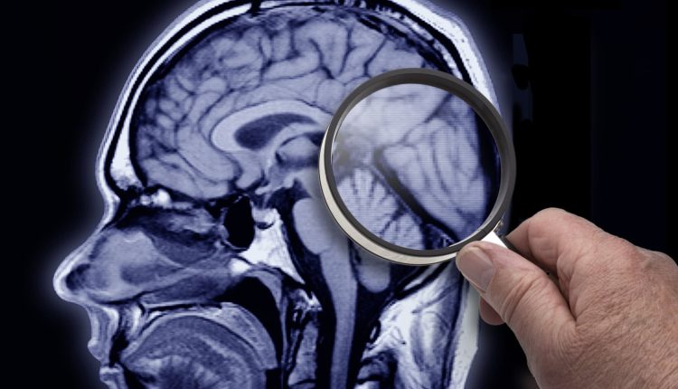 FDA Approves Biogen, Eisai Treatment Lecanemab

