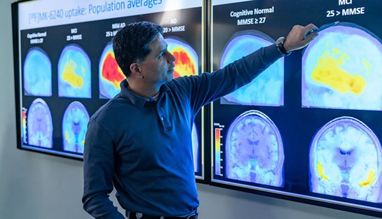 Alzheimer's patients see the benefits of Leqembi even when it is stopped

