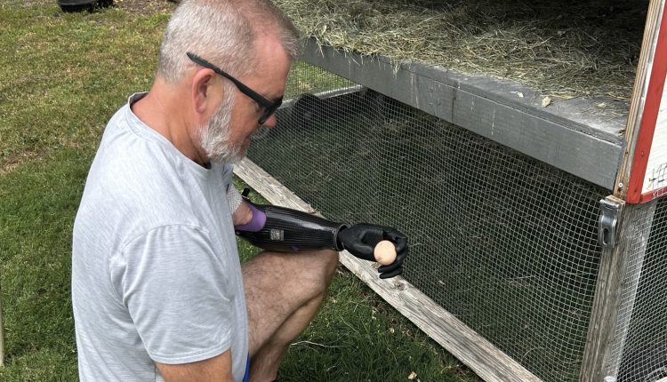 Aether Biomedical, bionic hand startup, gets $5.8 million to scale