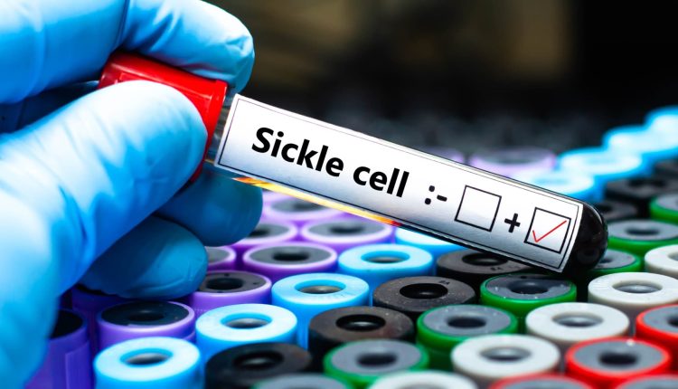 Sickle cell disease gene therapies Casgevy Lyfgenia insurance cost issues