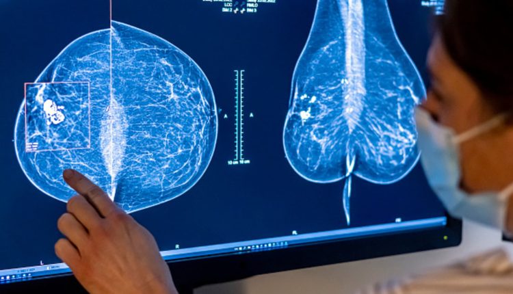 The financial toxicity of cancer is increasing. This is how we reduce it

